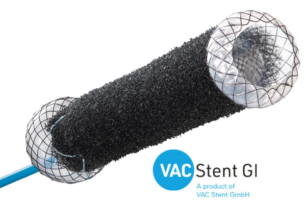 vac-stent-gi-xl-galerie-2